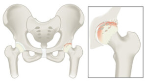 HipArthritis