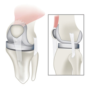 Knee Replacement