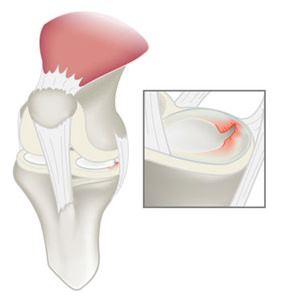 Meniscus Tear Knee