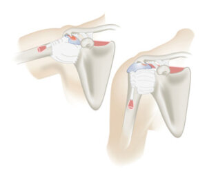 Shoulder Impingement