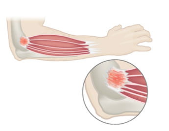 Lateral And Medial Epicondylitis Summit Orthopedics