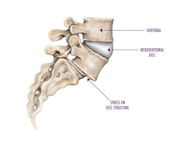 Spondylolysis-with-captions_isolated_600x450