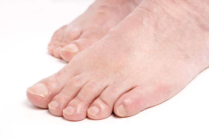 Could That Ache In Your Big Toe Be Gout Summit Orthopedics