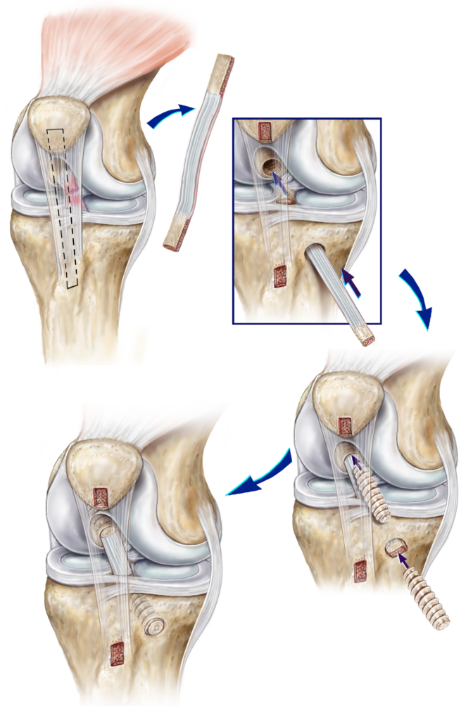 Anterior Cruciate Ligament (ACL) Tears