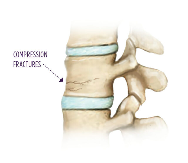 Spine Care Anatomy of a compression fracture