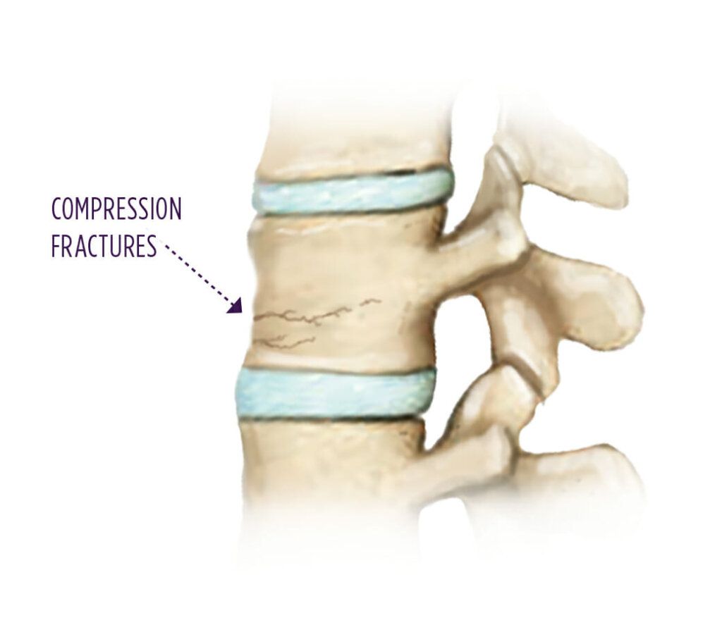 Spine Care Anatomy of a compression fracture
