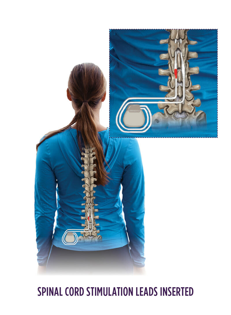 Spinal Cord Stimulator - Patient Experience 