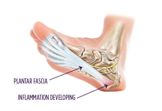 Depiction of the flantar fascia and how inflammation develops into plantar fasciitis.