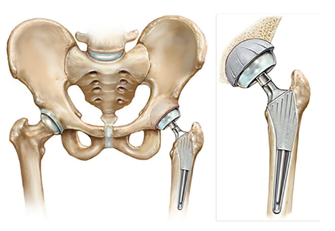 https://www.summitortho.com/wp-content/uploads/2019/01/TOTAL_HIP_REPLC_no-box-outline_digital.2.jpg