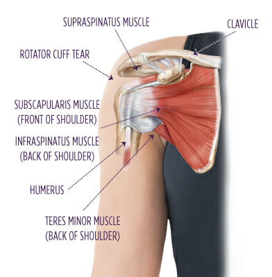 Best Self-Treatment of a Rotator Cuff Tear