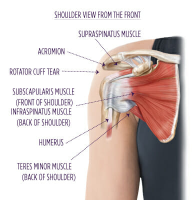 Rotator Cuff Surgery