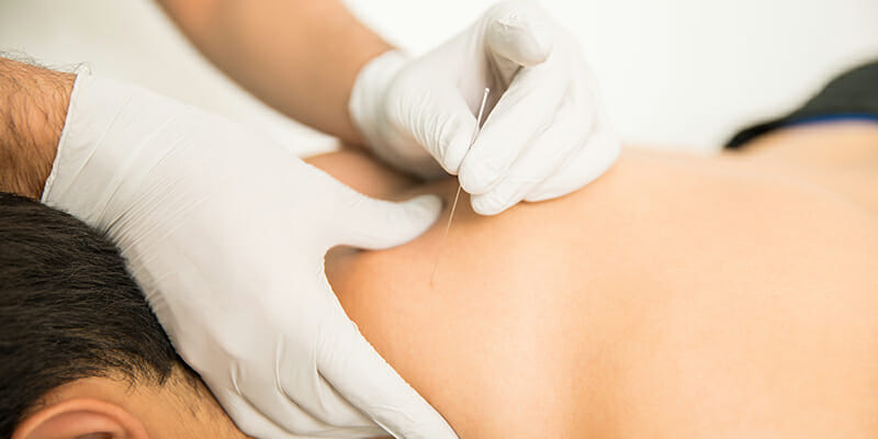 What Is Dry Needling?