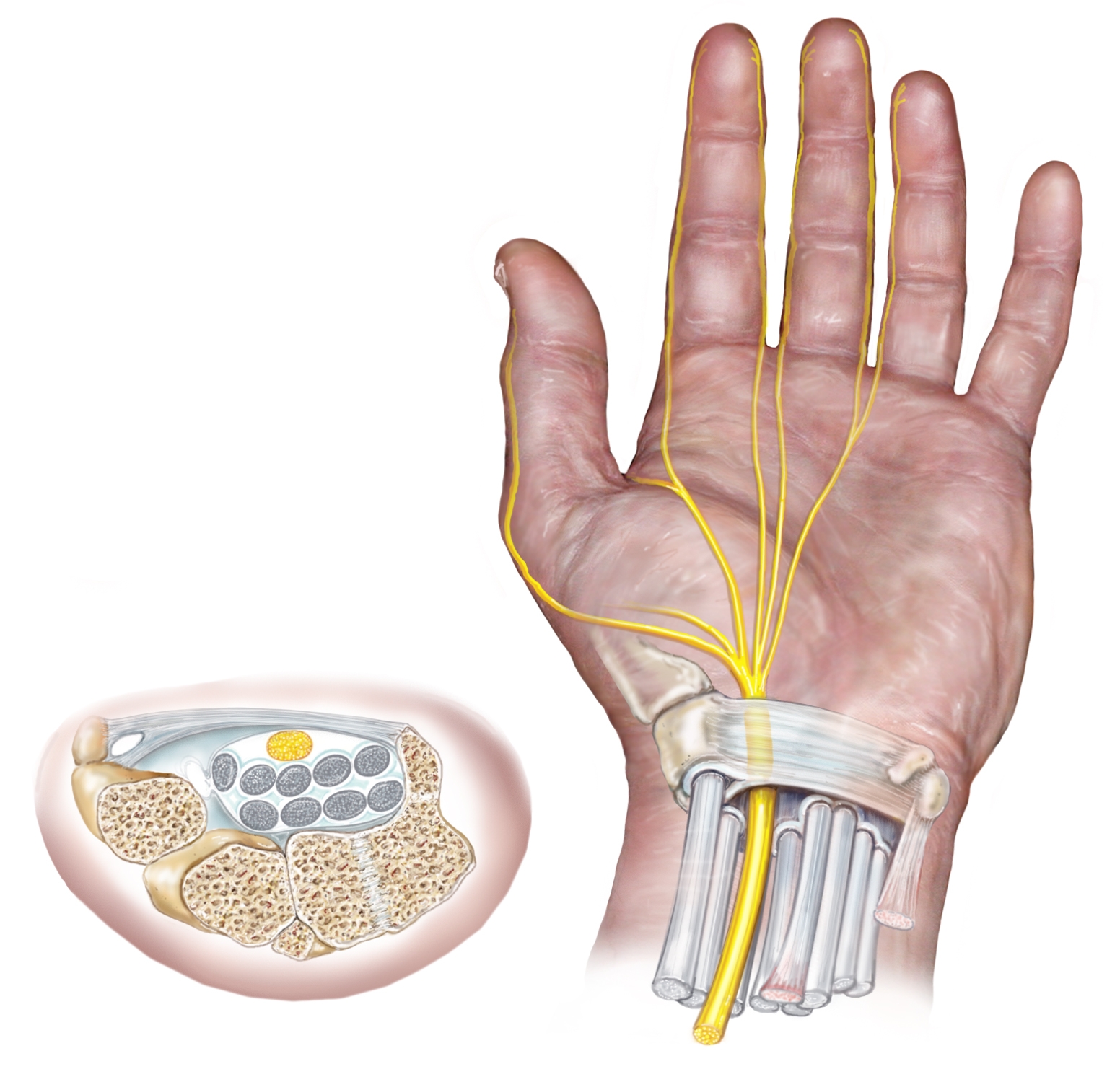 Carpal Tunnel Example