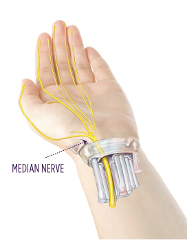 Carpal Tunnel Median Nerve Example