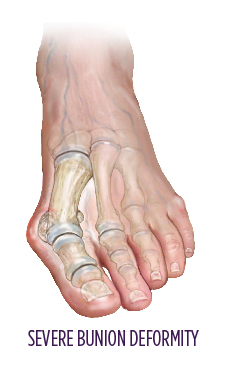 severe bunion example